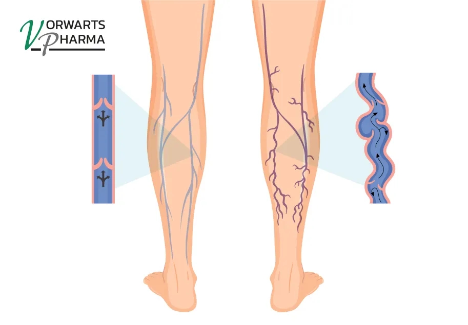 Varicose Veins: Symptoms, Prevention, and Vein Support with Flego Varicose Veins: Symptoms, Prevention, and Vein Support with Flego
